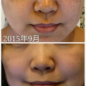 會員開心分享：淡斑